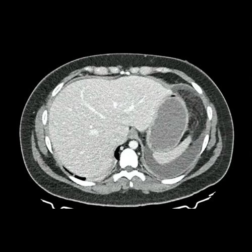 Paciente femenina de 24 años con peritonitis infecciosa
