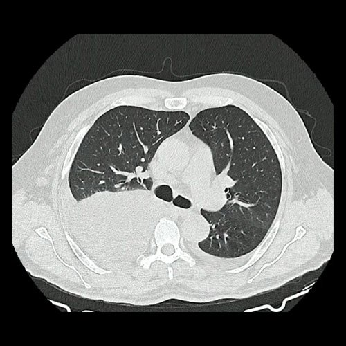 Tomografía de abdomen con contraste (día 4)