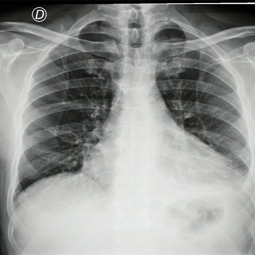 Paciente masculino de 62 años con derrame pleural y pericárdico