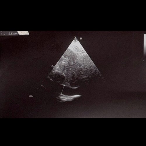 Ecocardiograma (dia 6): VCI 25mm