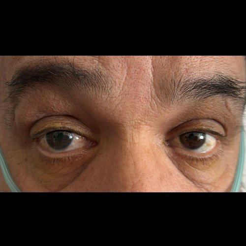 Presión intraocular ojo derecho (dia 9): 40 mmHg