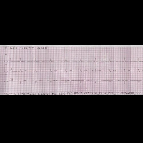 Electrocardiograma (dia 6): Ritmo sinusal, regular, FC 70-80 lpm. Eje desviado a la izquierda sin Sokolow-Lyon ni Cornell. Sin signos de isquemia aguda ni arritmias.