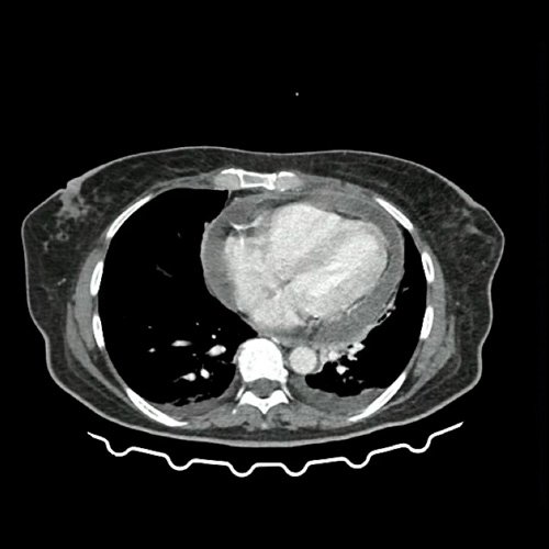 Anexo 1: TAC de tórax con contraste, corte axial. DÍA 0 06/09/2025