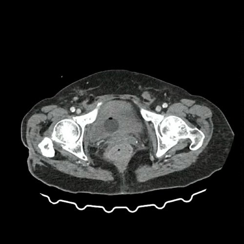 Anexo 2: TAC de pelvis con contraste, corte axial. DÍA 0 06/09/2025