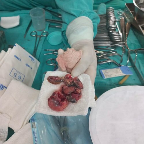 Material trombótico extraído asociado a válvula pulmonar