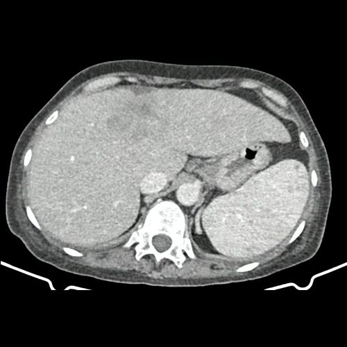TAC de abdomen y pelvis (internación previa)