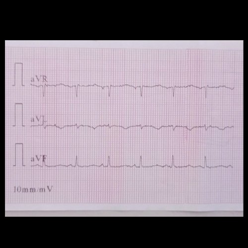 ECG (día 31)