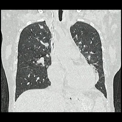TAC de tórax (internación previa) 