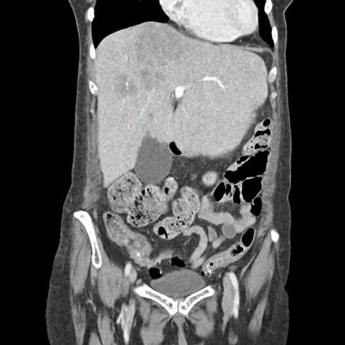 TAC de abdomen y pelvis (Dia 30)