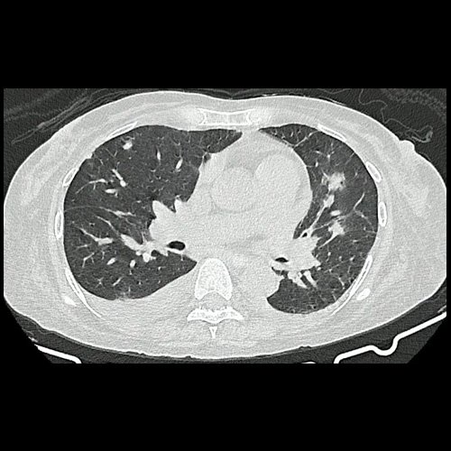 TAC de tórax (Dia 31)