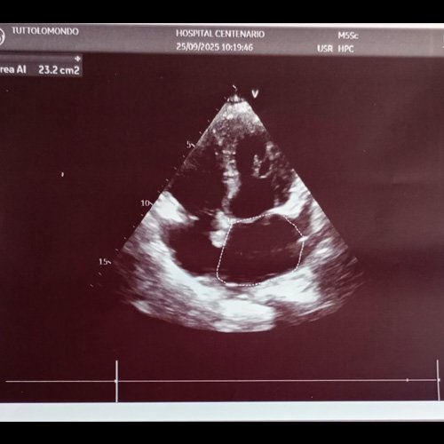 Ecocardiograma (Dia 31)