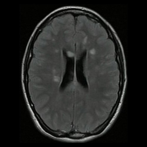 Día 2: RMI de cráneo (T2 Flair-corte axial). Lesiones hiperintensas nodulares sólidas en sustancia blanca en centros semiovales y cuerpo calloso.