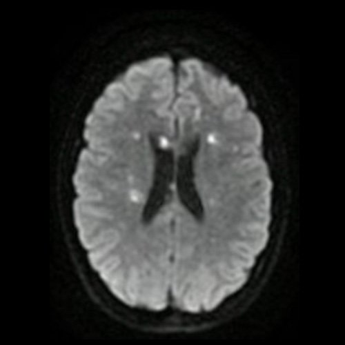 Día 2: RMI de cráneo (difusión – corte axial). Lesiones nodulares sólidas en sustancia blanca en centros semiovales y cuerpo calloso con restricción en difusión.