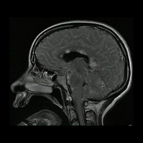 Día 2: RMI de cráneo ( T2 Flair – corte parasagital). Lesiones hiperintensas nodulares sólidas en cuerpo calloso  en protuberancia.centros semiovales y cuerpo calloso con restricción en difusión.