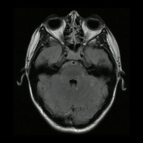 Día 2: RMI de cráneo ( T2 Flair – corte axial). Lesiones hiperintensas nodulares sólidas en protuberancia, pedúnculos cerebelosos y hemisferios cerebelosos.