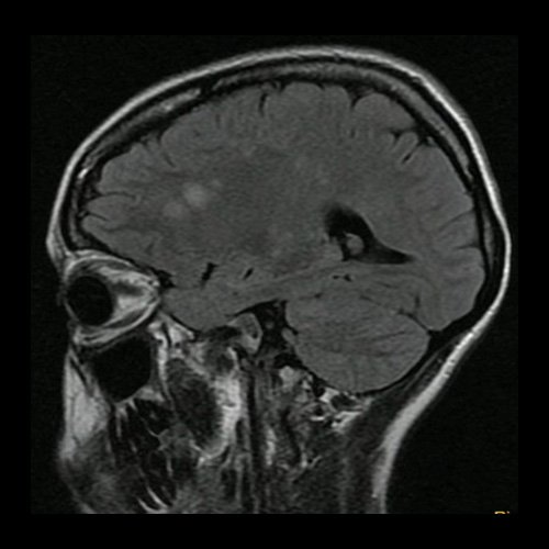 Día 5: RMI de cráneo (T2 Flair – corte parasagital). Lesiones hiperintensas nodulares sólidas en región frontal.