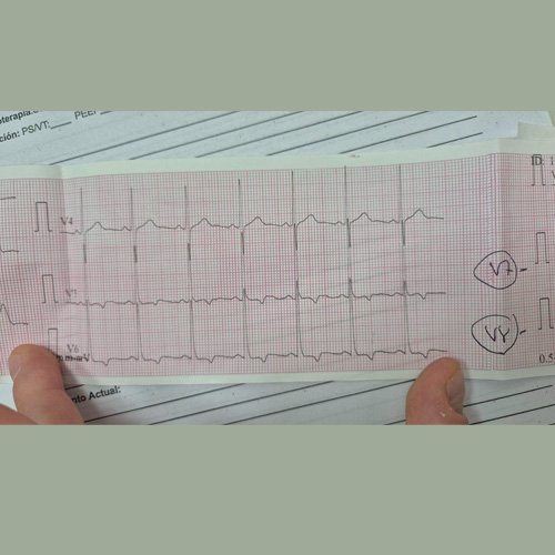 Electrocardiograma Dia 12