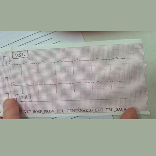 Electrocardiograma Dia 12
