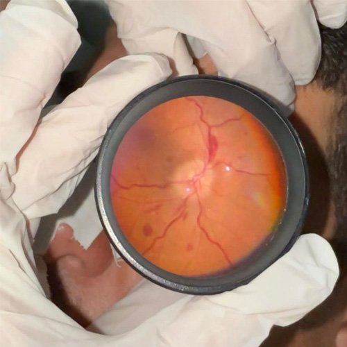 RMI de cráneo con contraste (Día 4): corte axial