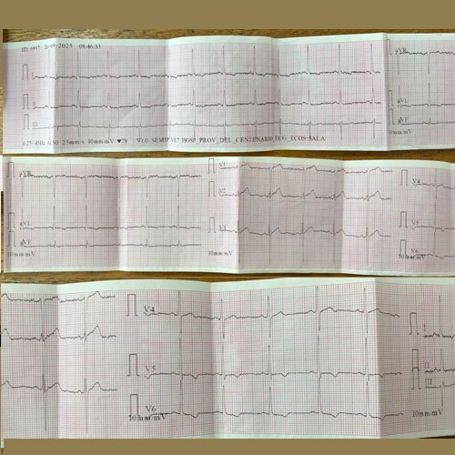 Varón joven con hipertensión arterial resistente y hemorragia intraparenquimatosa