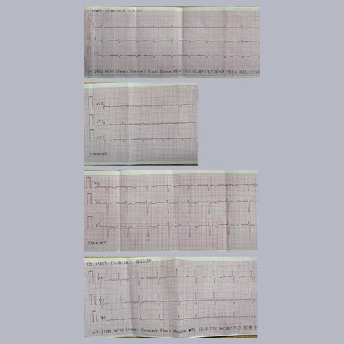 Electrocardiograma A: Día 3