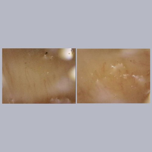 Capilaroscopia día 5. Imagen brindada por Servicio de Reumatología 