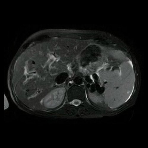 RMI de abdomen Corte axial (08/06/25)