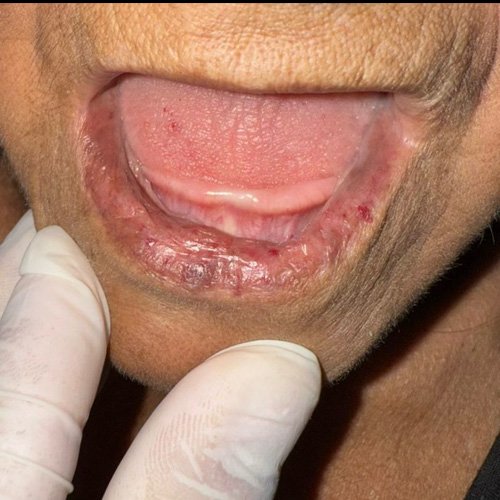 Lesiones en cara