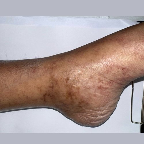 Pies en garra, con telangiectasias y edema 