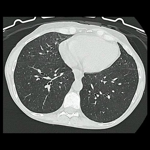 Mujer de 50 años con debut de sindrome ascítico edematoso y enfermedad autoinmune