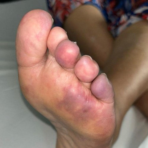 Pie izquierdo (DÍA 0)