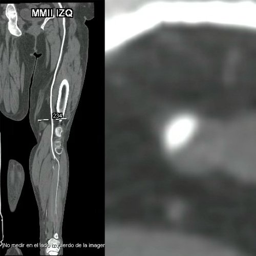 Angio TAC de miembro inferior izquierdo con contraste EV corte coronal (DÍA 0)