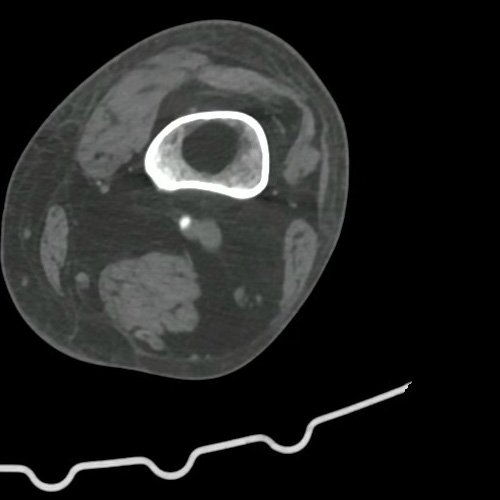 Angio TAC de miembro inferior izquierdo con contraste EV corte coronal (DÍA 0)