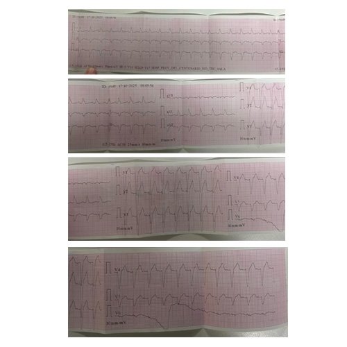 Electrocardiograma (DÍA 1)