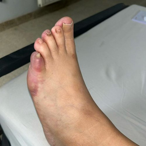 Mujer joven con dolor y cianosis en región distal del pie izquierdo.