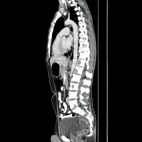 TAC de columna con contraste EV (Corte sagital y corte coronal):  Presenta múltiples lesiones líticas óseas, bien circunscritas, que afectan en forma difusa todos los cuerpos vertebrales, sacro, pelvis ósea, esternón, clavícula y escápulas.además se desta