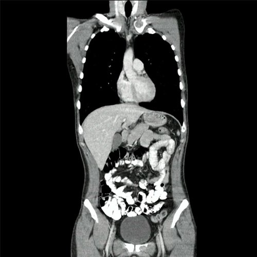 TAC de columna con contraste EV (Corte sagital y corte coronal):  Presenta múltiples lesiones líticas óseas, bien circunscritas, que afectan en forma difusa todos los cuerpos vertebrales, sacro, pelvis ósea, esternón, clavícula y escápulas.además se desta