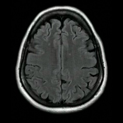 Anexo 2. Angio RMI de cráneo: Corte transversal. Secuencia t2 flair