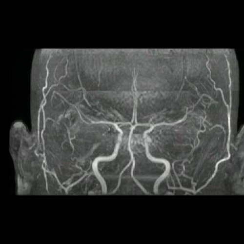 Anexo 3. Angio RMI de cráneo. Reconstrucción 3d. 