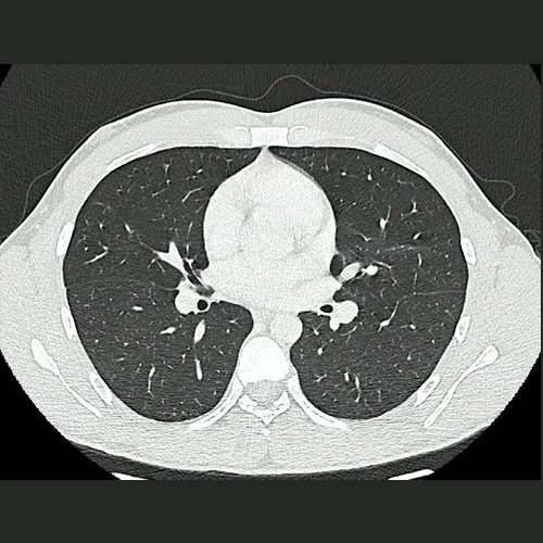 TAC de tórax corte coronal y axial previas (23/10/24)