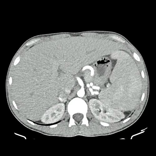 TAC de abdomen corte axial previas 22/11/24