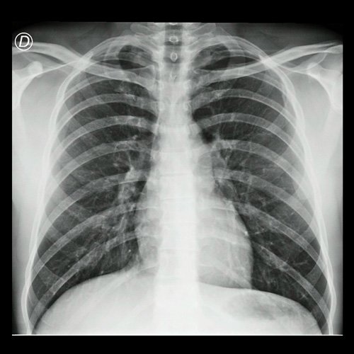 Radiografía de tórax frente y perfil  Día 3 