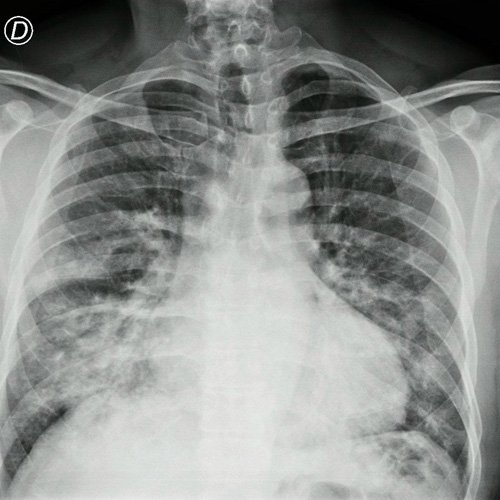 Radiografía de tórax frente y perfil