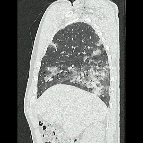 Tomografía de tórax sin contraste endovenosos (Ventana pulmonar- corte sagital)