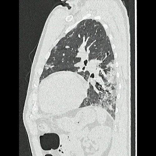 Tomografía de tórax sin contraste endovenosos (Ventana pulmonar- corte sagital)