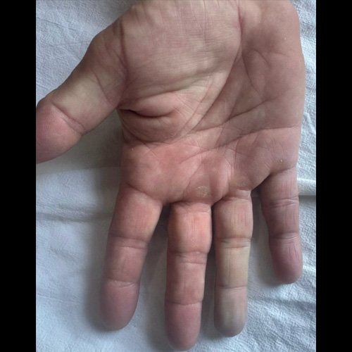 Fotografías de dedo anular derecho 