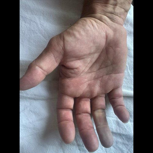 Fotografías de dedo anular derecho 