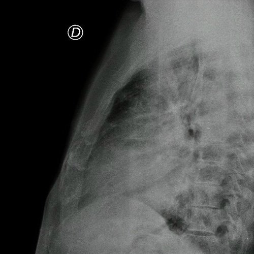 Radiografía de tórax frente y perfil