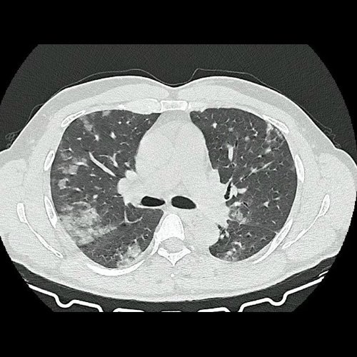 Tomografia de torax sin contraste endovenosos (Ventana pulmonar-corte axial)
