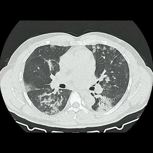 Tomografia de torax sin contraste endovenosos (Ventana pulmonar-corte axial)